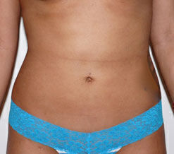 Liposuction Before & After Image