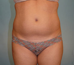 Liposuction Before & After Image