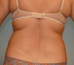 Liposuction Before & After Image