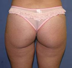 Liposuction Before & After Image