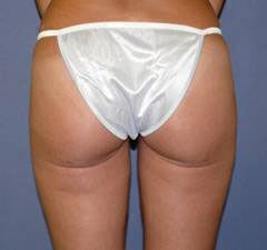 Liposuction Before & After Image