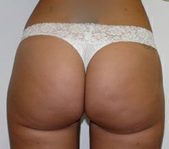 Liposuction Before & After Image