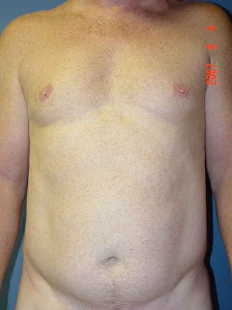 Liposuction Before & After Image