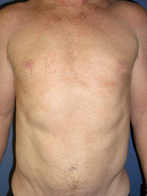 Liposuction Before & After Image