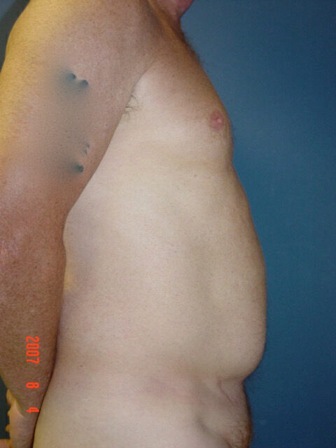 Liposuction Before & After Image