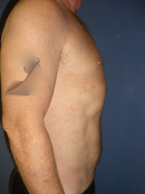 Liposuction Before & After Image