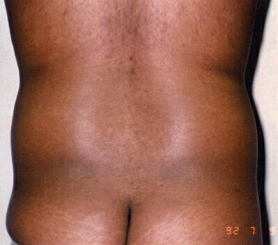 Liposuction Before & After Image