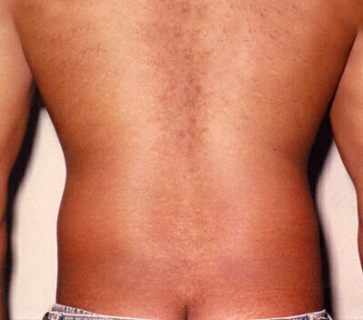 Liposuction Before & After Image