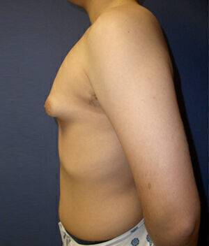 Liposuction Before & After Image