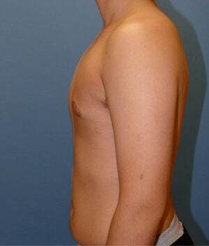 Liposuction Before & After Image