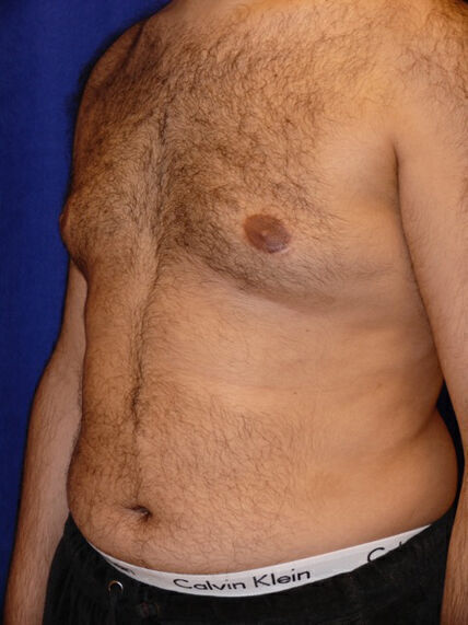 Liposuction Before & After Image