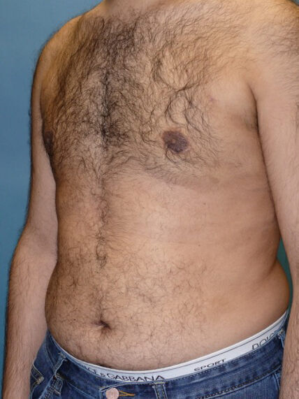 Liposuction Before & After Image