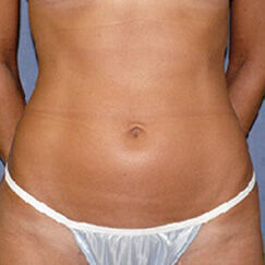 Liposuction Before & After Image