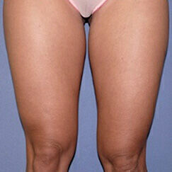 Liposuction Before & After Image