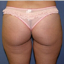 Liposuction Before & After Image