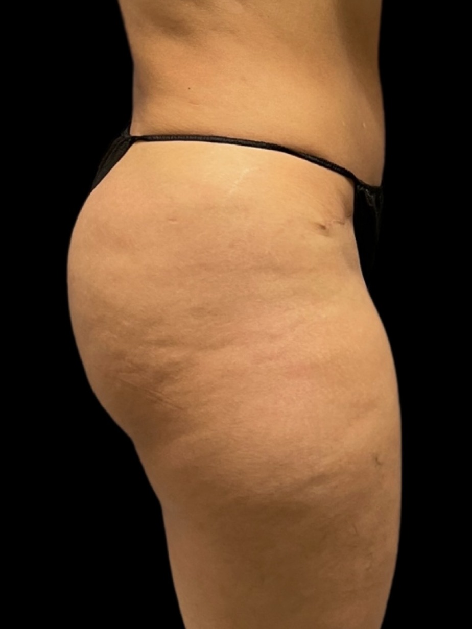 Revision Brazilian Butt Lift Before & After Image