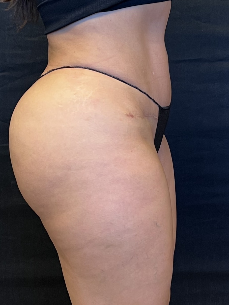 Revision Brazilian Butt Lift Before & After Image