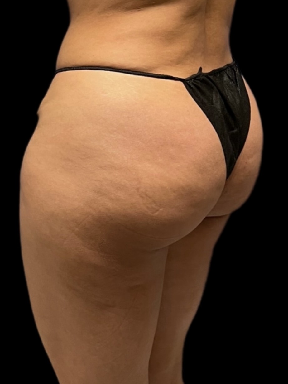 Revision Brazilian Butt Lift Before & After Image