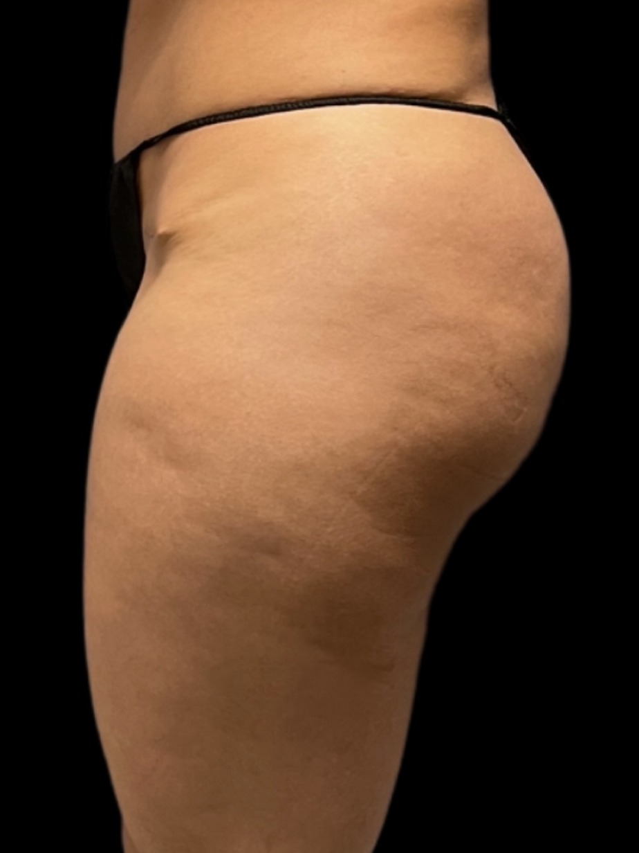 Revision Brazilian Butt Lift Before & After Image