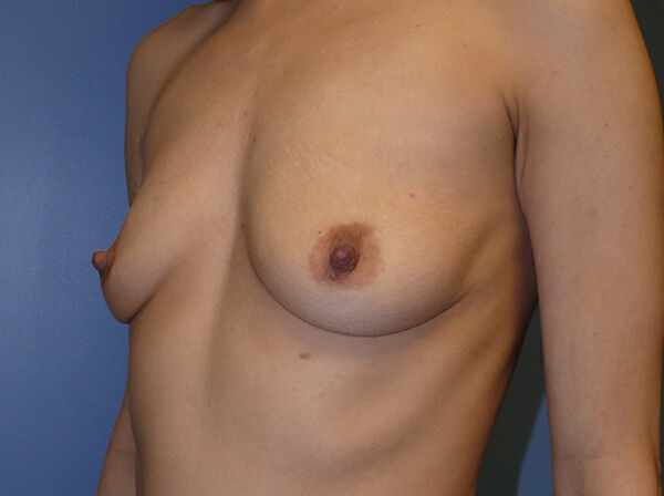 Breast Augmentation Before & After Image