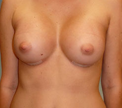 Breast Augmentation Before & After Image