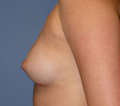 Breast Augmentation Before & After Image