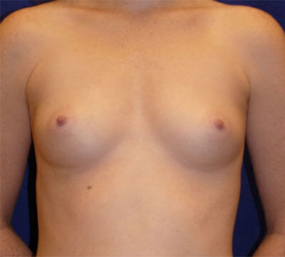 Breast Augmentation Before & After Image