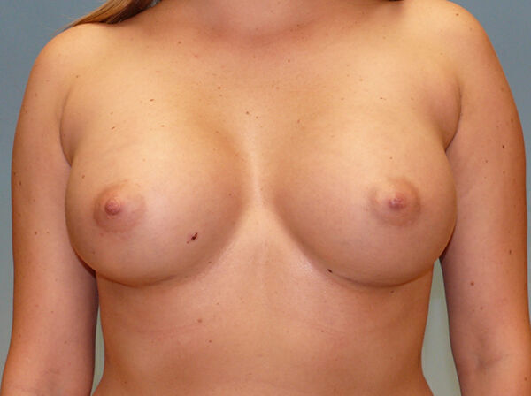 Breast Augmentation Before & After Image