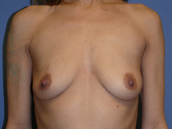 Breast Augmentation Before & After Image