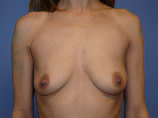 Breast Augmentation Before & After Image