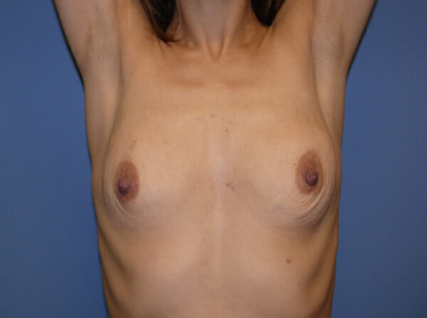 Breast Augmentation Before & After Image