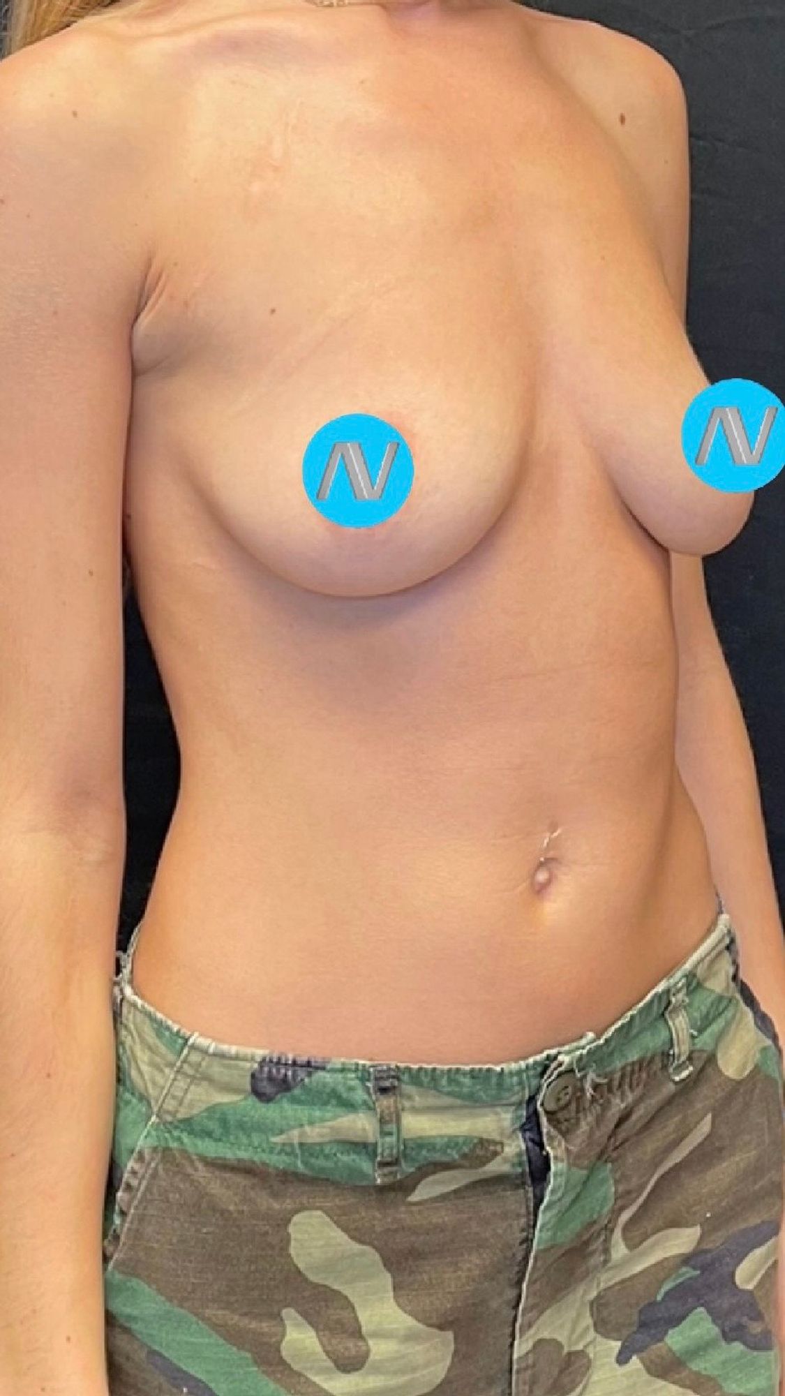 Breast Augmentation Before & After Image