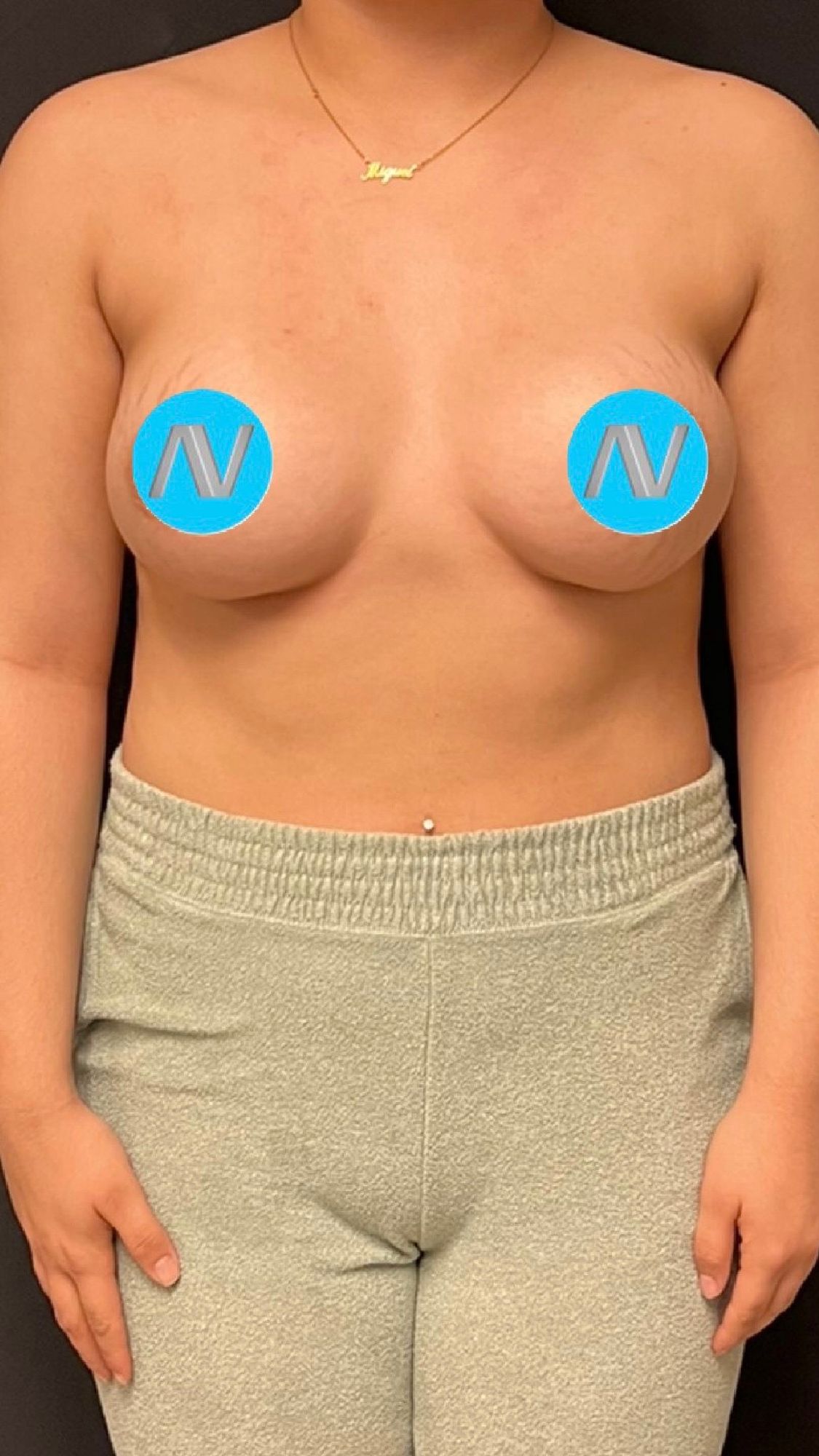 Breast Augmentation Before & After Image