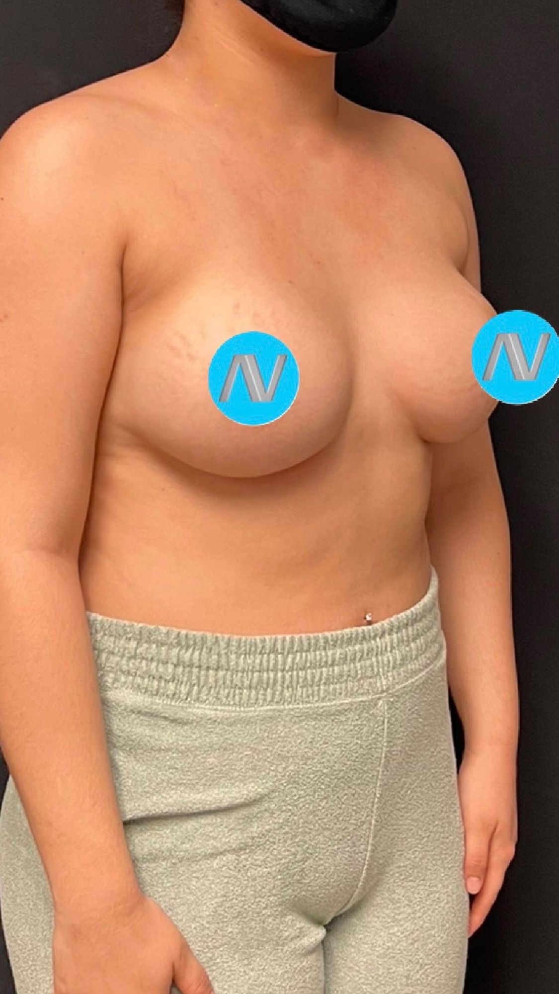 Breast Augmentation Before & After Image