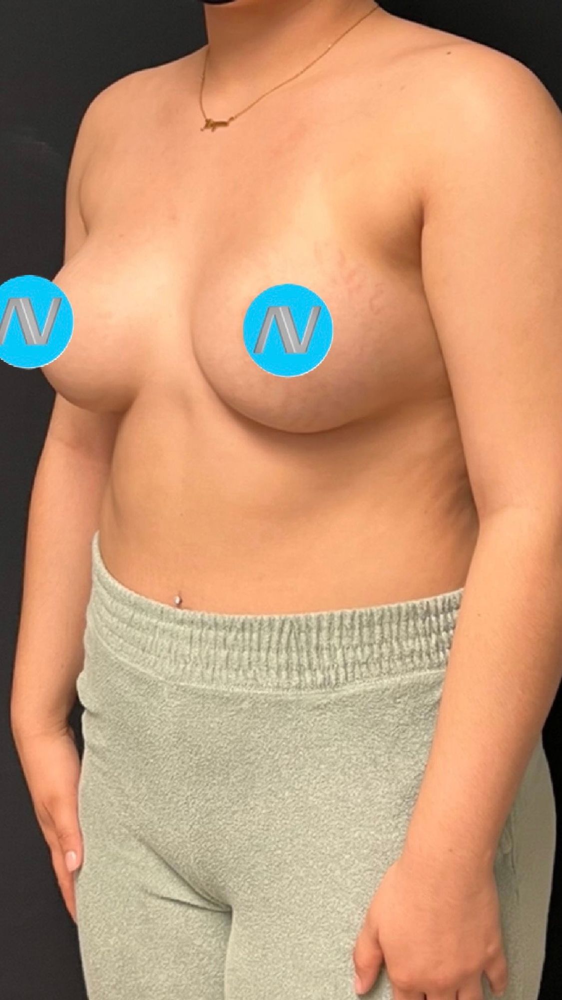 Breast Augmentation Before & After Image