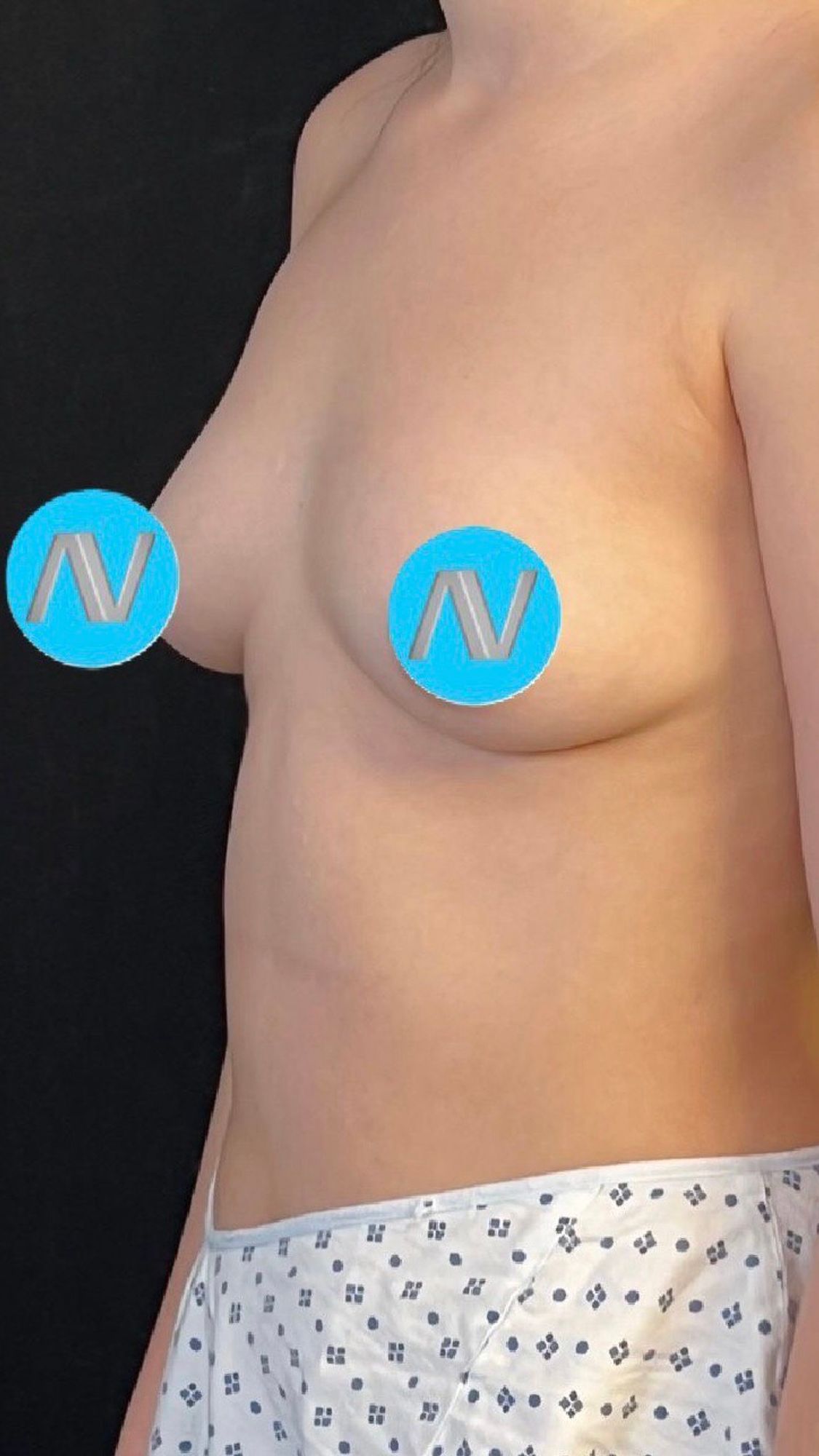 Breast Augmentation Before & After Image