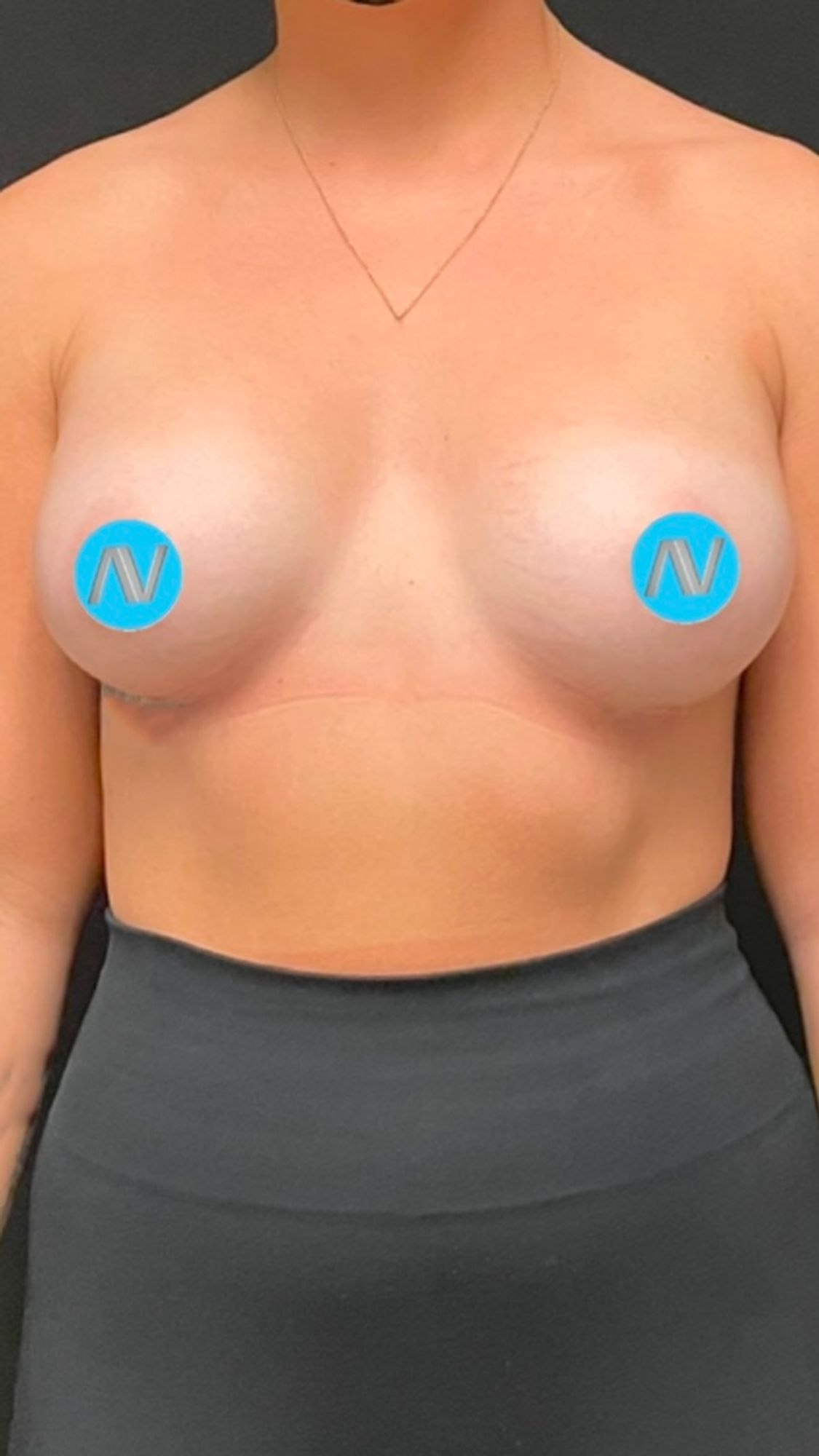 Breast Augmentation Before & After Image