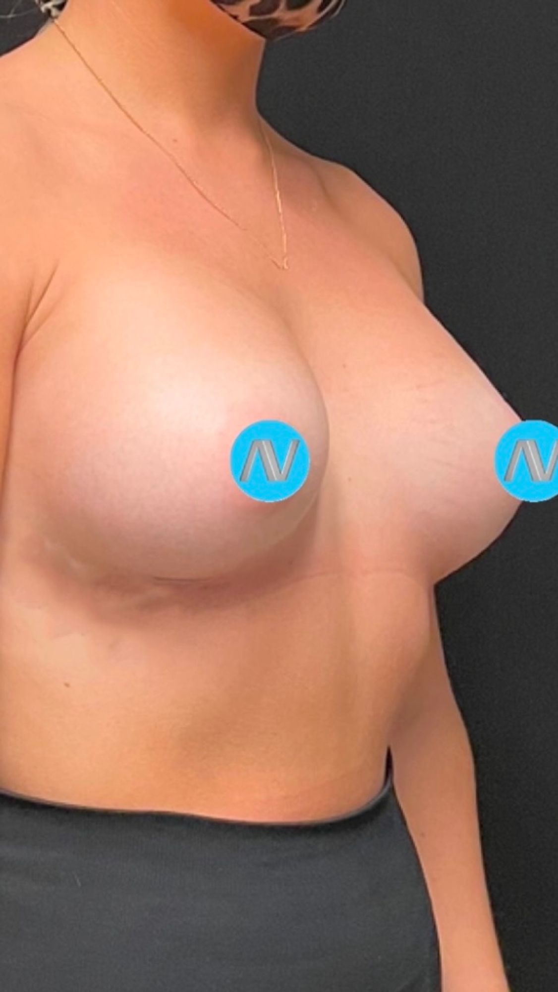 Breast Augmentation Before & After Image