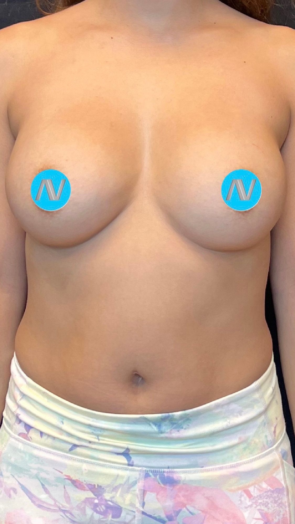 Breast Augmentation Before & After Image