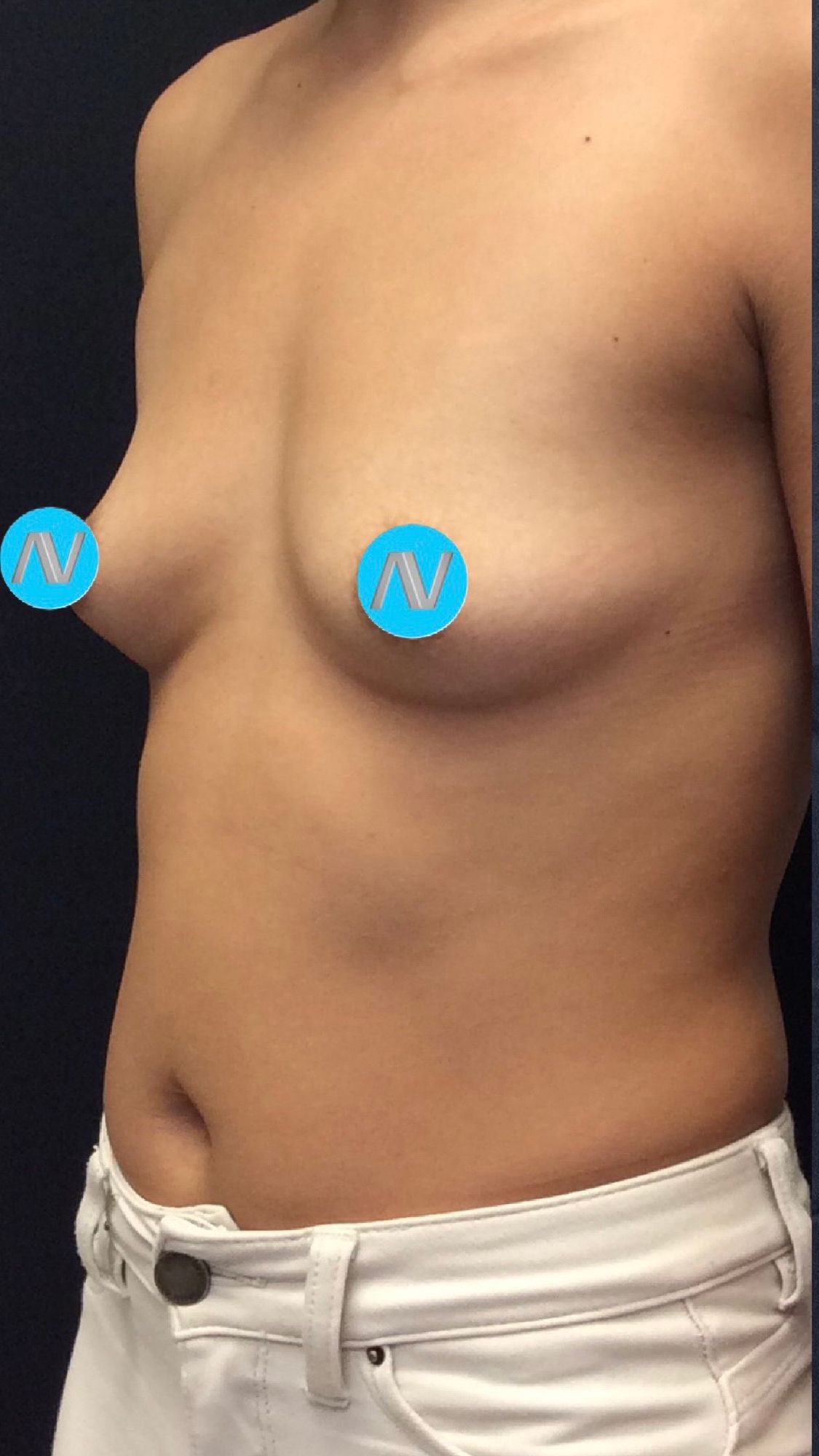 Breast Augmentation Before & After Image