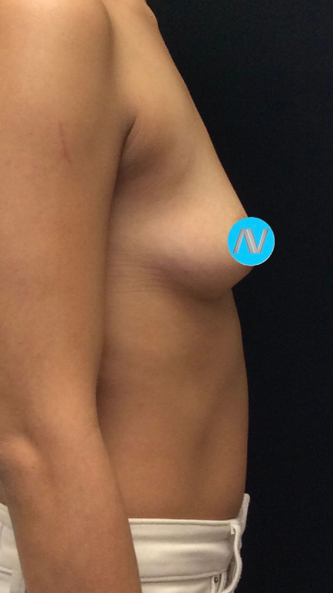 Breast Augmentation Before & After Image