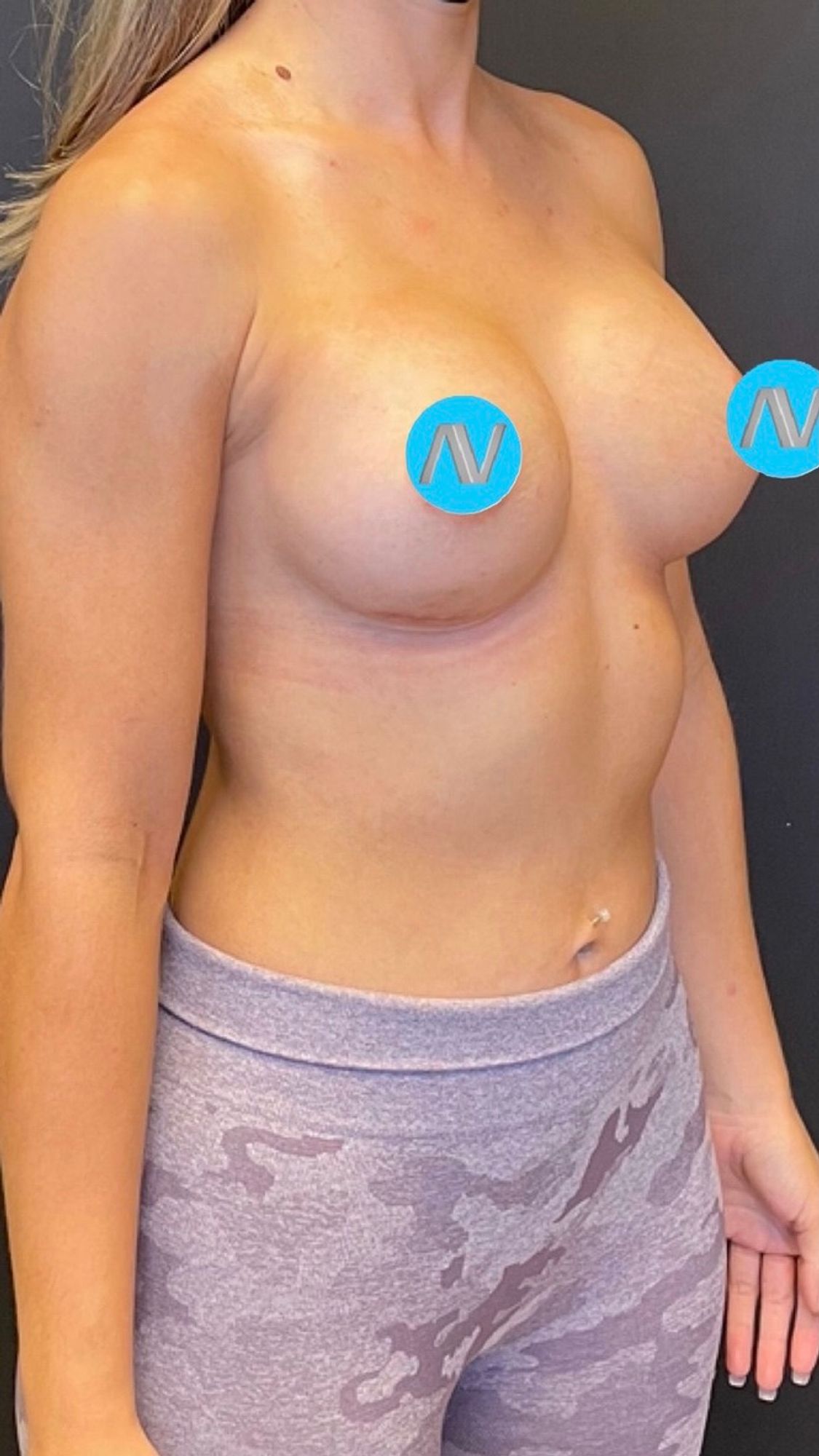 Breast Augmentation Before & After Image