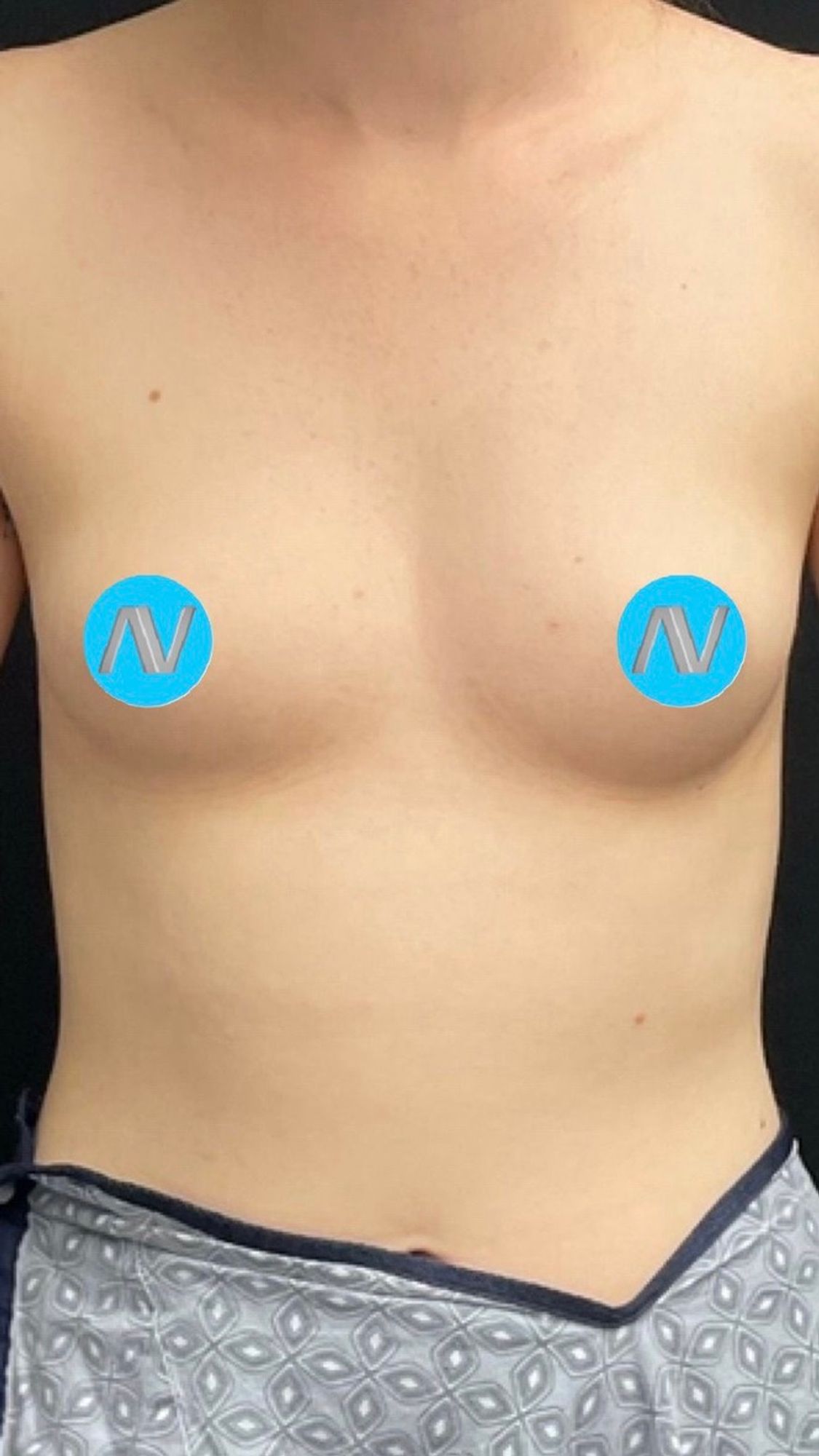 Breast Augmentation Before & After Image