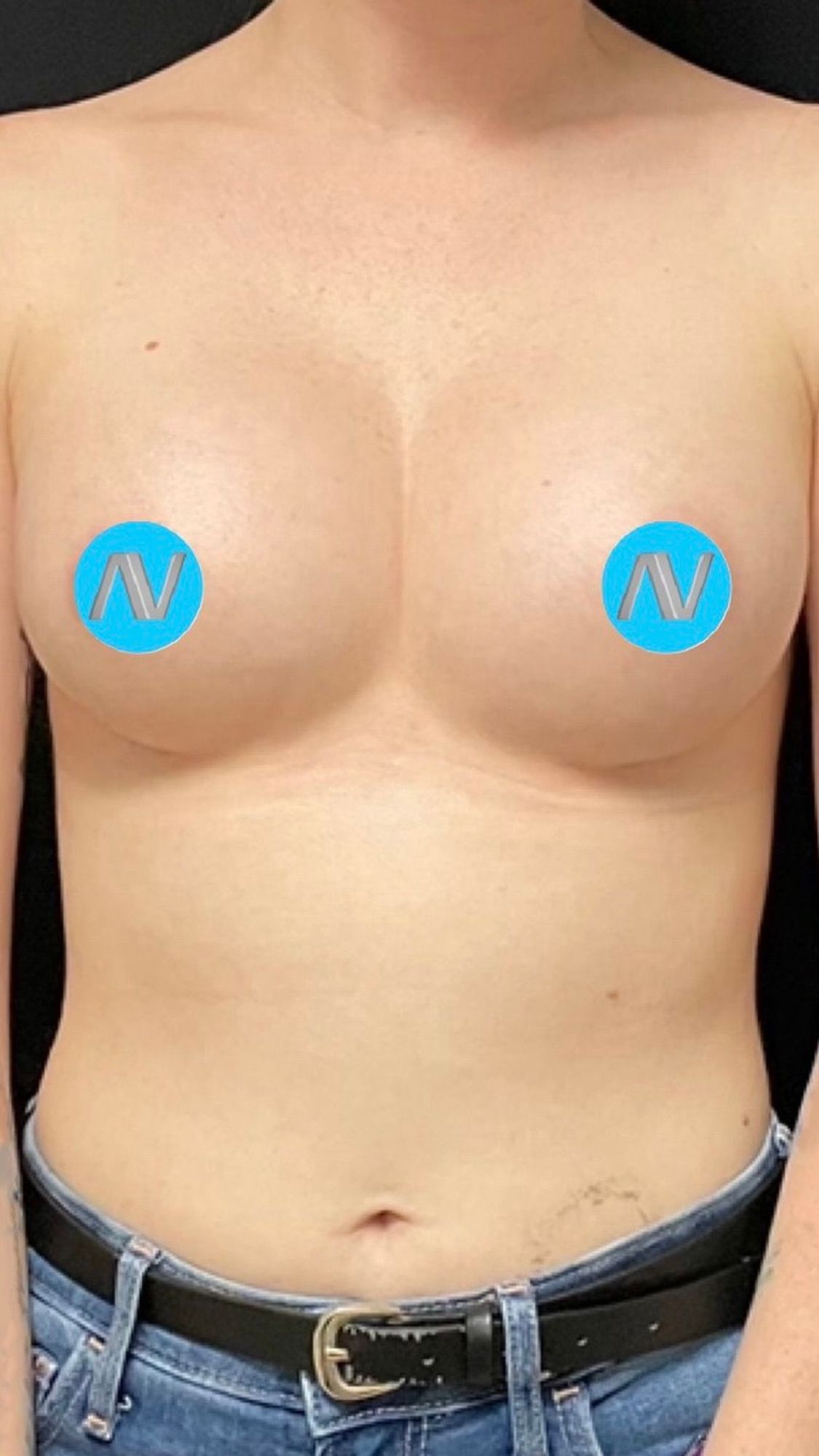 Breast Augmentation Before & After Image