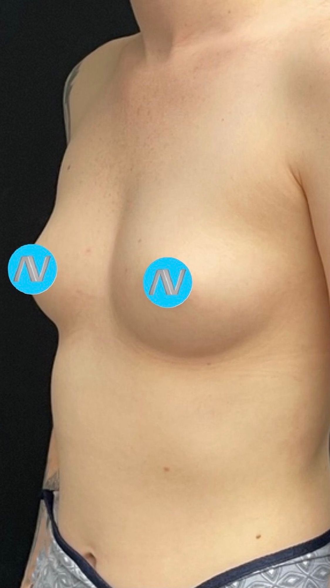 Breast Augmentation Before & After Image