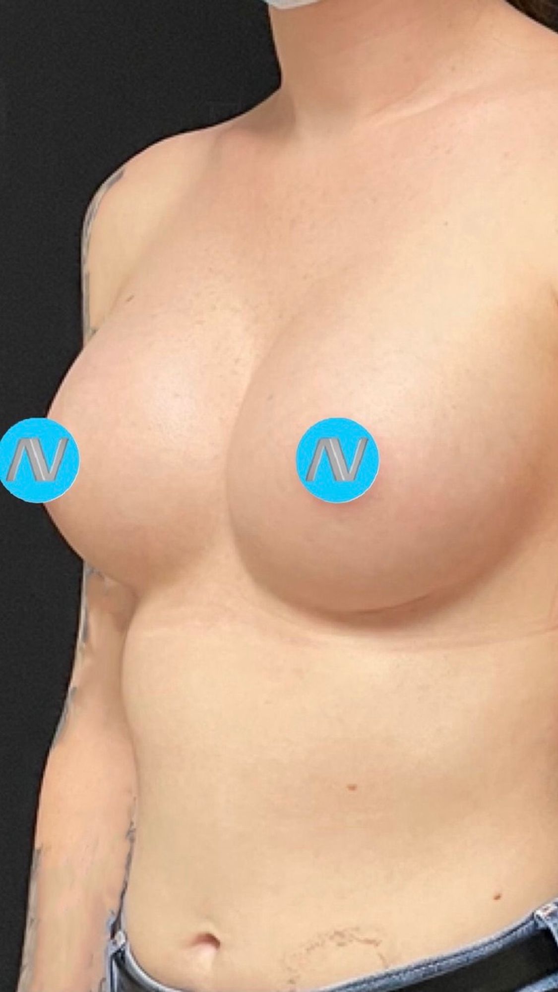 Breast Augmentation Before & After Image