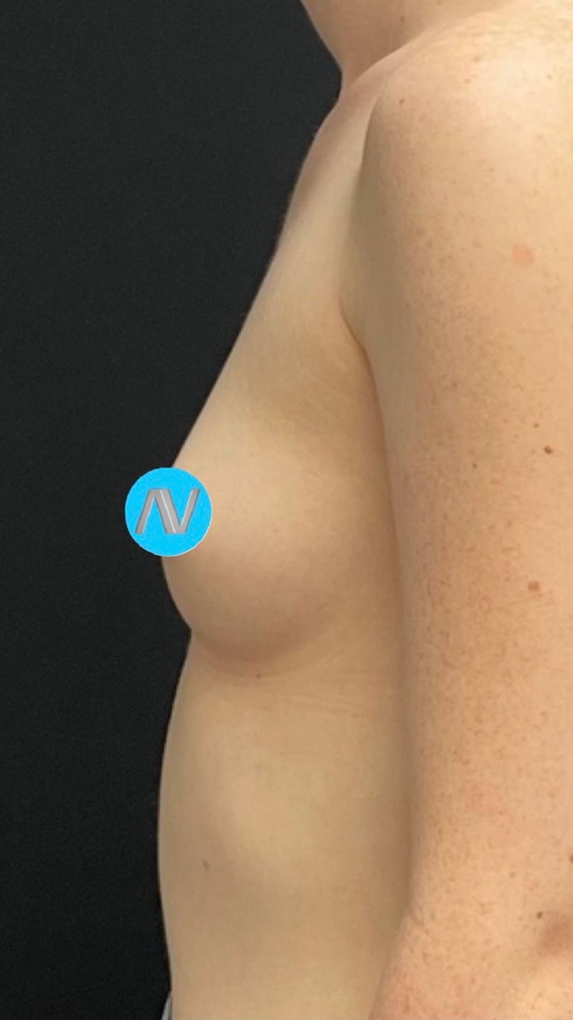 Breast Augmentation Before & After Image