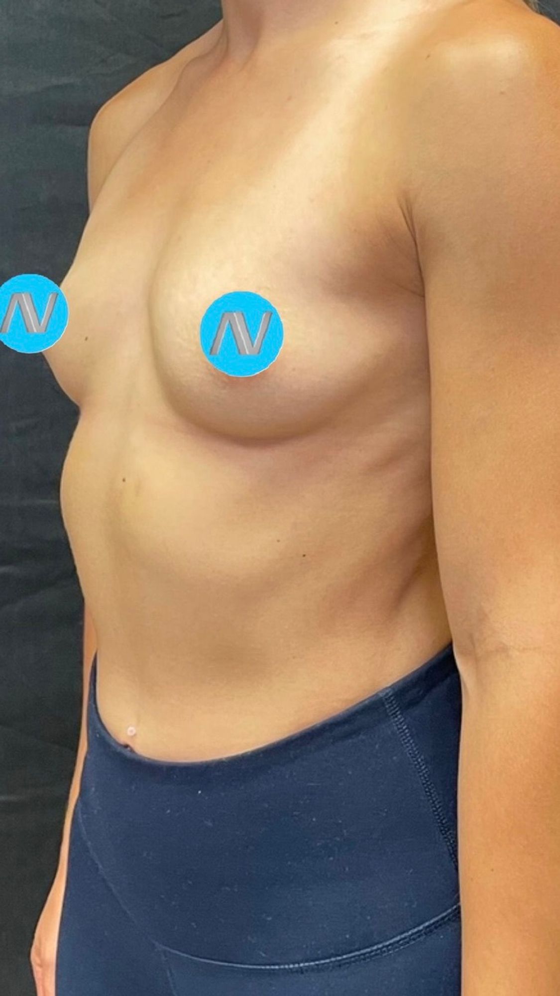 Breast Augmentation Before & After Image