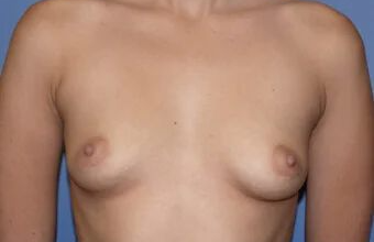 Breast Augmentation Before & After Image