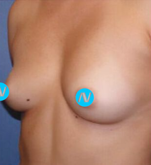 Breast Augmentation Before & After Image